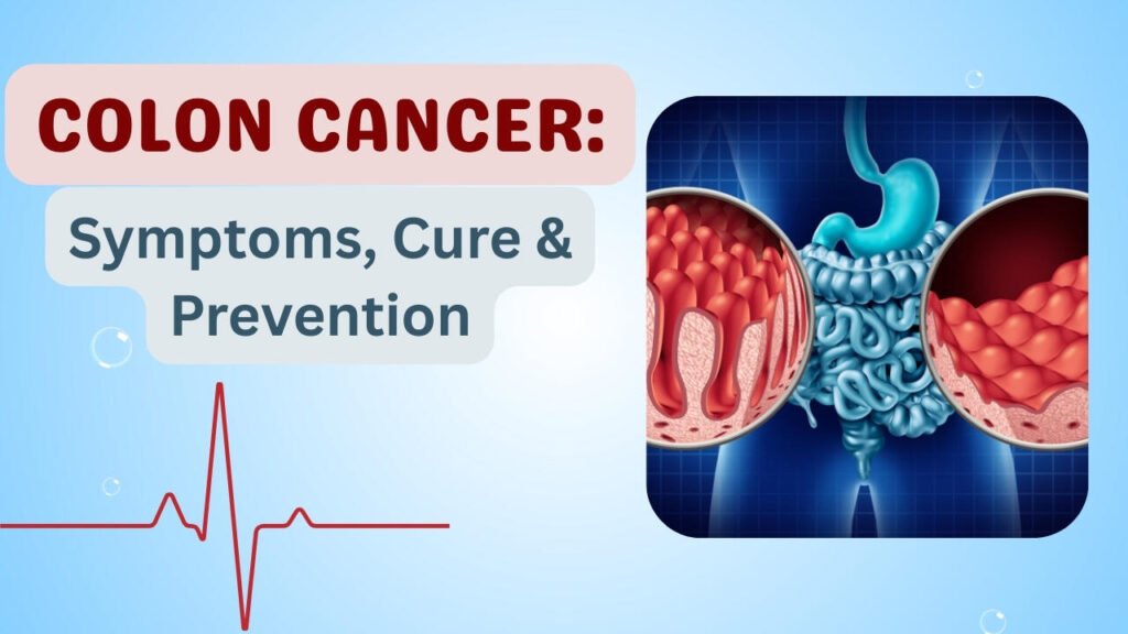 Colon cancer
